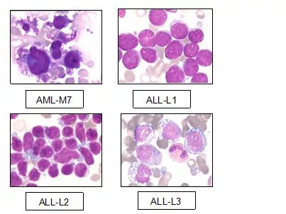 全血细胞减少疾病，你还傻傻分不清？