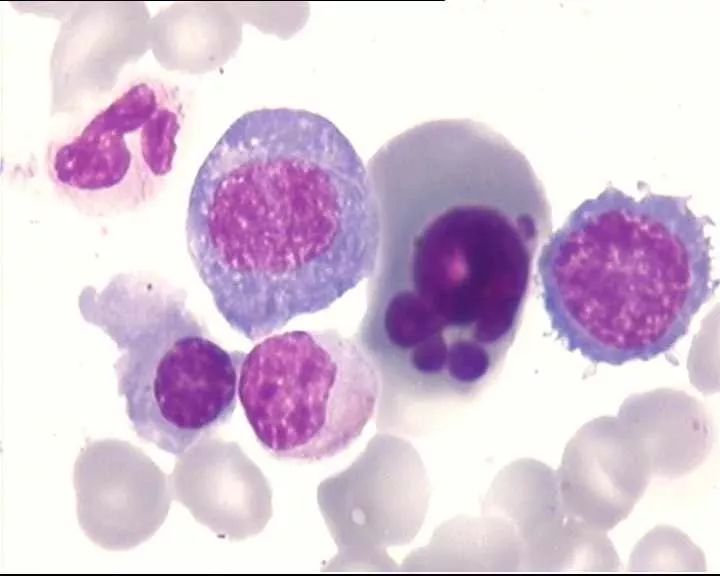 全血细胞减少疾病，你还傻傻分不清？