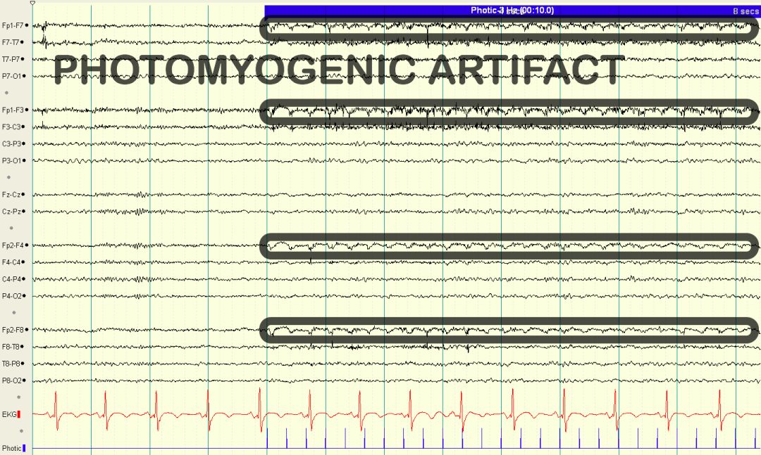 脑电图伪差图,脑电图伪差图谱