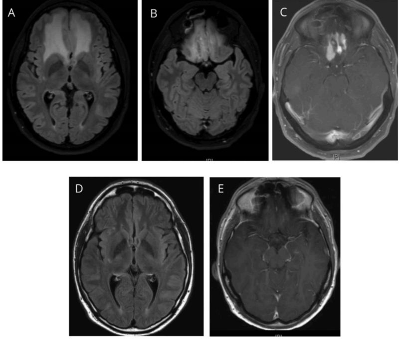 高氨血症有哪些表现,高氨血症