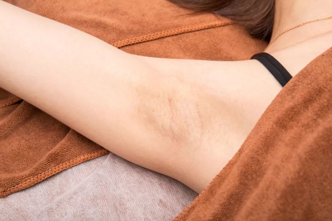 脱毛轻轻松松告别夏日尴尬,脱毛最好的季节