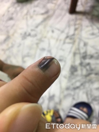 指头发黑坏死是怎么回事,指头紫发黑怎么回事