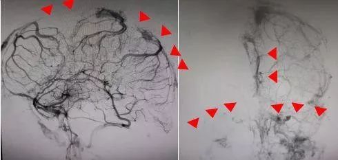 26岁小伙加班后头晕,28岁小伙熬夜加班49小时