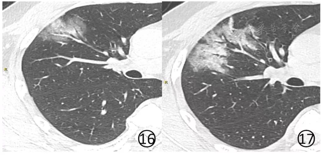 新冠肺炎影像演变过程,新冠肺炎胸部影像学特点有哪些