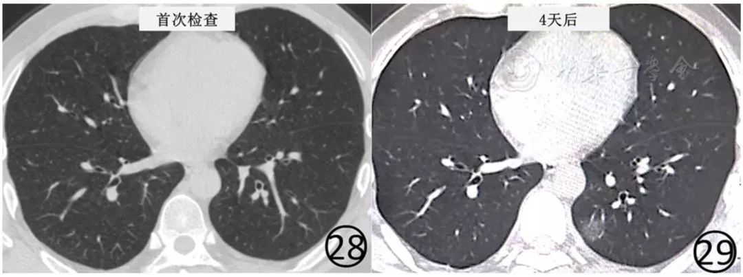 新冠肺炎影像演变过程,新冠肺炎胸部影像学特点有哪些