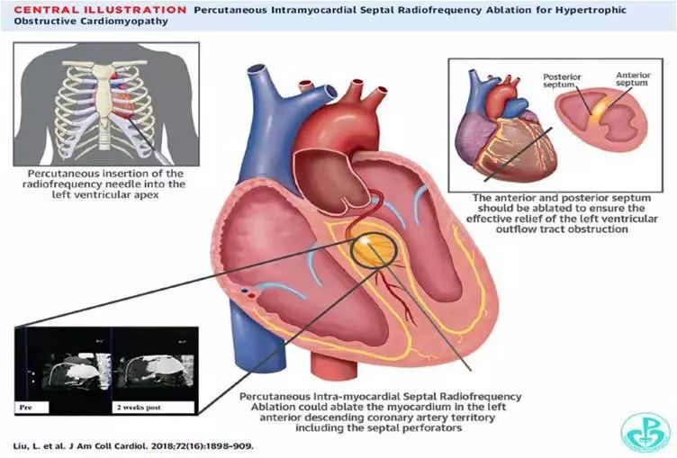扩张型心肌病用什么消融,梗阻性肥厚性心肌病开胸手术恢复