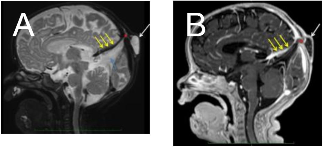 小孩后脑勺枕骨一侧有凸起骨头,七岁的小孩后脑勺一侧有凸起骨头