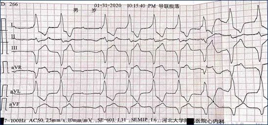 一度房室传导阻滞是怎么得的,三度房室传导阻滞最简单看法