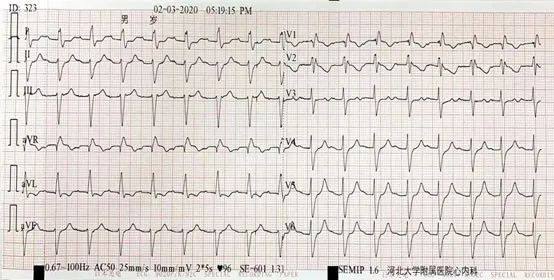 病例丨“一波三折”的三度房室传导阻滞，原因何在？