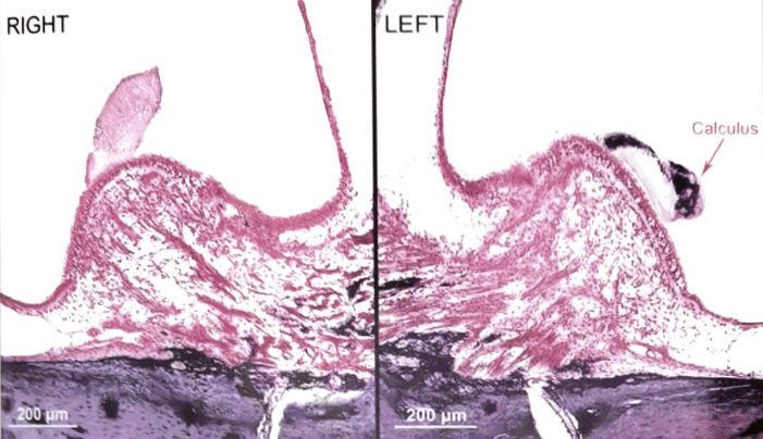 22张图，细说梅尼埃病的组织病理学特点丨“晕”筹帷幄