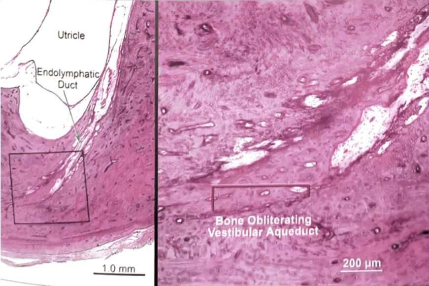 梅尼埃病深度解析,梅尼埃病病理解剖