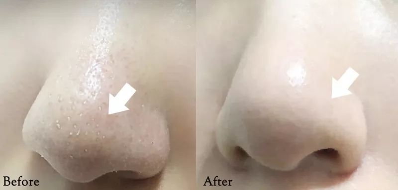 10鍒嗛挓娓呴櫎榛戝ご绮夊埡,榛戝ご绮夊埡鎸ゅ帇娓呯悊姣涘瓟绮楀ぇ