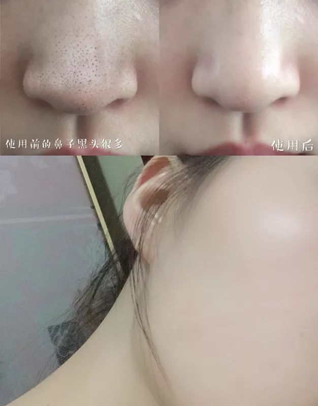 10鍒嗛挓娓呴櫎榛戝ご绮夊埡,榛戝ご绮夊埡鎸ゅ帇娓呯悊姣涘瓟绮楀ぇ