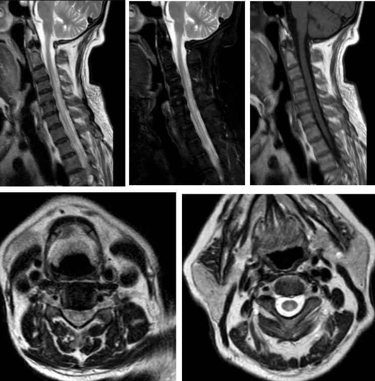 枫糖尿病、血管型梅毒、Hopkins综合征、Susac综合征丨3分钟读片·2期