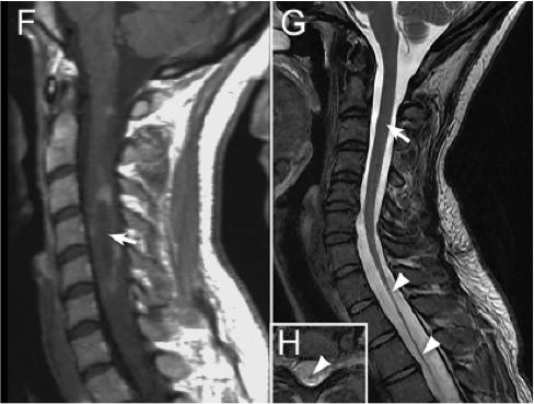 张星虎视神经脊髓炎,张星虎多发性硬化