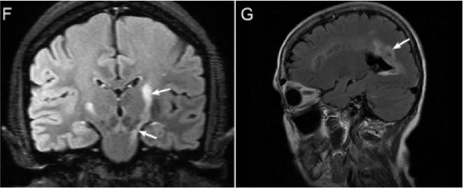 张星虎视神经脊髓炎,张星虎多发性硬化
