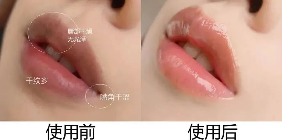 嘴唇干裂起皮等皮掉了涂唇膏,嘴唇干脱皮用什么唇部护理比较好?