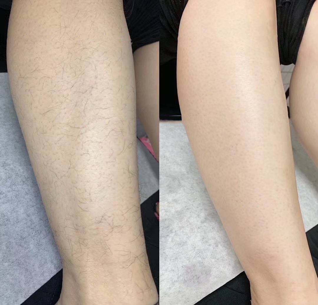 有没有一款真正永久脱毛的脱毛膏,你还在用剃须刀刮胡子吗