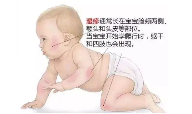 护理科普宝宝突发湿疹怎么办,宝宝湿疹护理科普