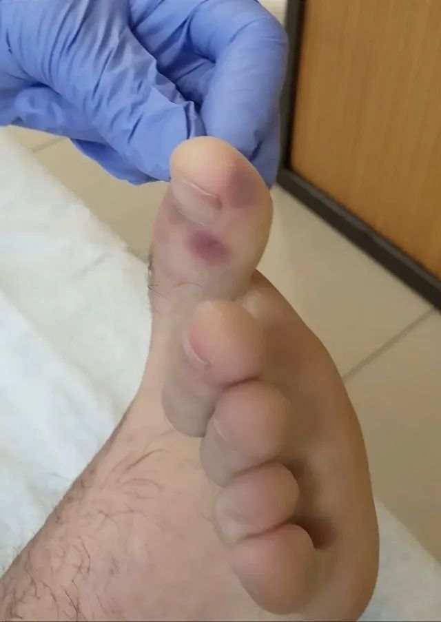 得了新冠病毒脸上出痘,新冠病毒最新症状脸上起痘痘