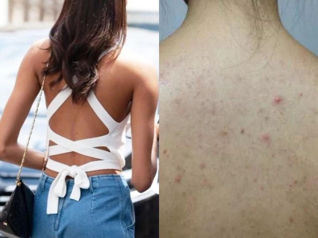 日本绿瓶的祛痘喷雾叫什么,清爽型祛痘喷雾