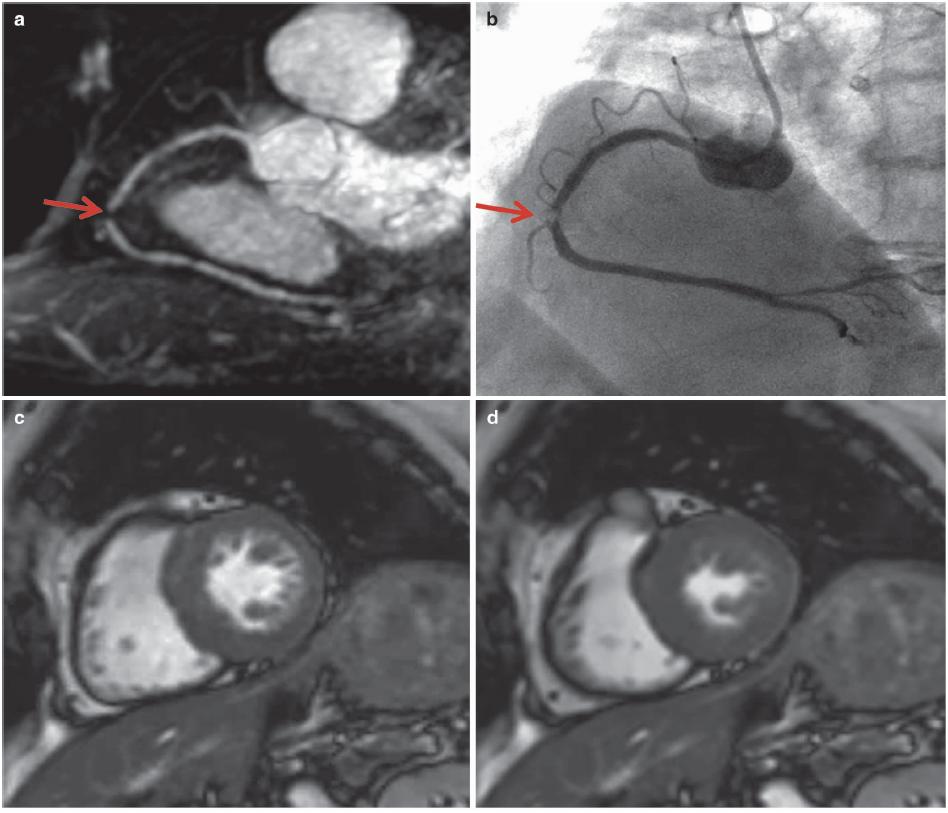 怎么看懂ct冠状动脉造影图片,冠状动脉造影图讲解