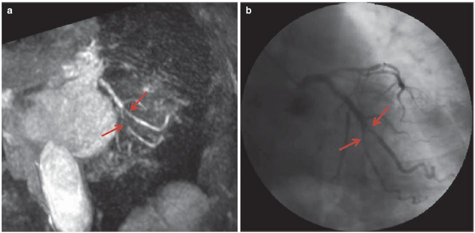 怎么看懂ct冠状动脉造影图片,冠状动脉造影图讲解