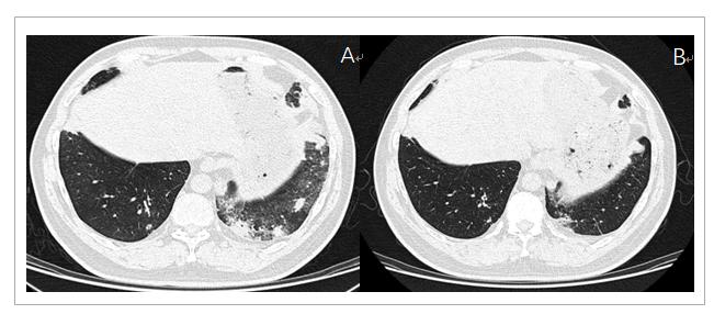 免疫治疗相关性肺炎处理,免疫治疗肺炎新进展