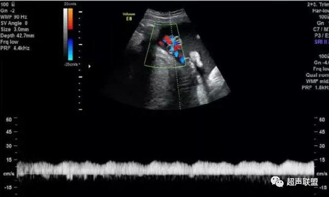 胎儿宫内窘迫通过什么检查出来的,胎儿宫内缺氧的超声视频