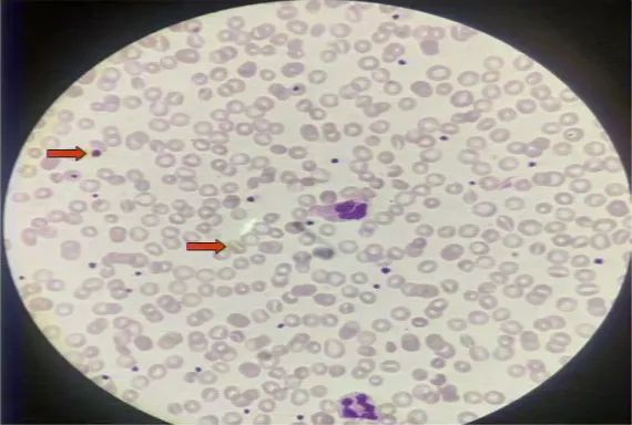 多发性黄色瘤,胆固醇高引起的黄色瘤是什么样的