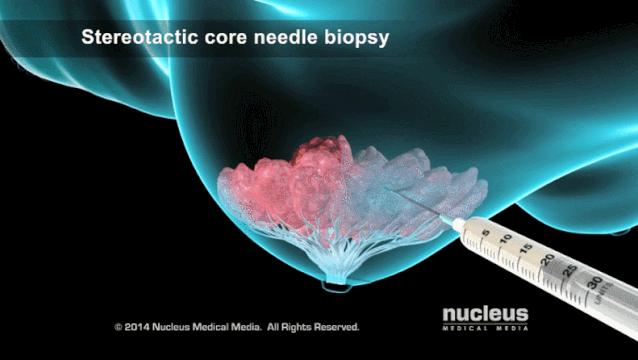 盘点医院各大科室侵入性检查：穿刺、内镜各显神通，小活检标本以“小”见“大”