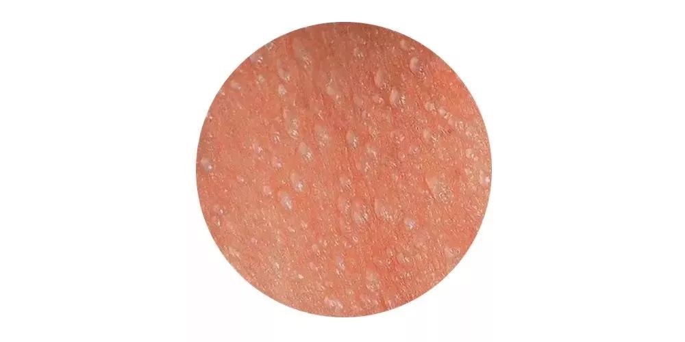 夏天预防治疗宝宝痱子的小方法,婴儿夏天防痱子用什么