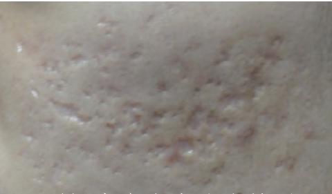 瘢痕体质留疤了怎么办,只有开刀才长疤是瘢痕体质吗