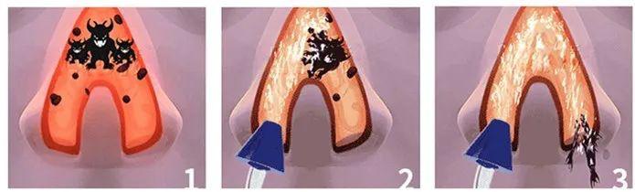 耳鼻喉鼻炎的自愈方法,过敏性鼻炎鼻腔清洗用什么