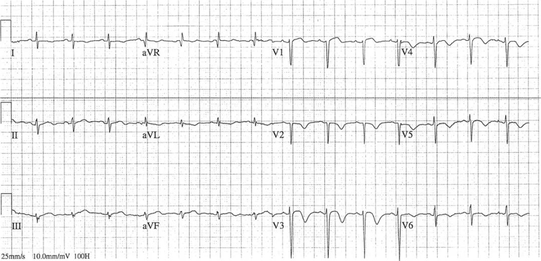24小时动态心电图有stt改变,心电图st段改变与st-t改变区别