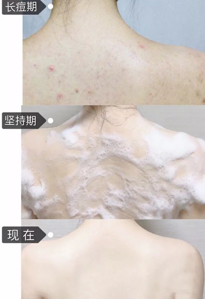 用什么洗脸抑制螨虫生长,用什么洗脸可以抑制螨虫生长