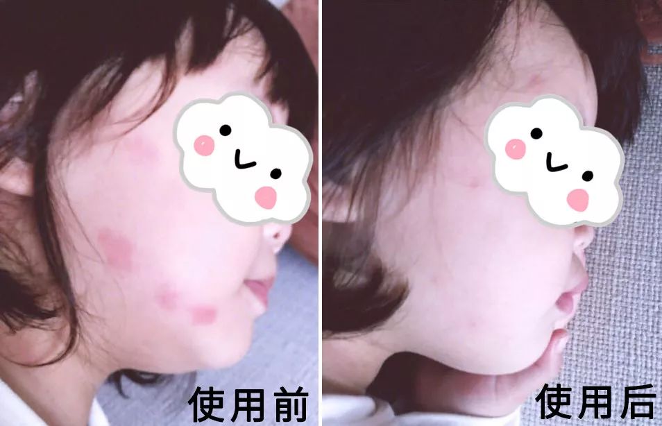 1罐搞定一整夏！20秒止痒消肿，让蚊虫再无嚣张机会