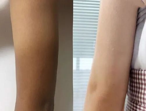 啤酒消痘痘,喝啤酒会消除痘痘吗