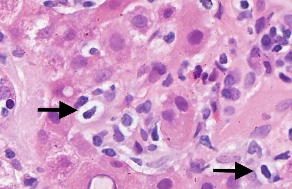 皮肤红疹有小水泡病例,病理性黄疸出现皮疹
