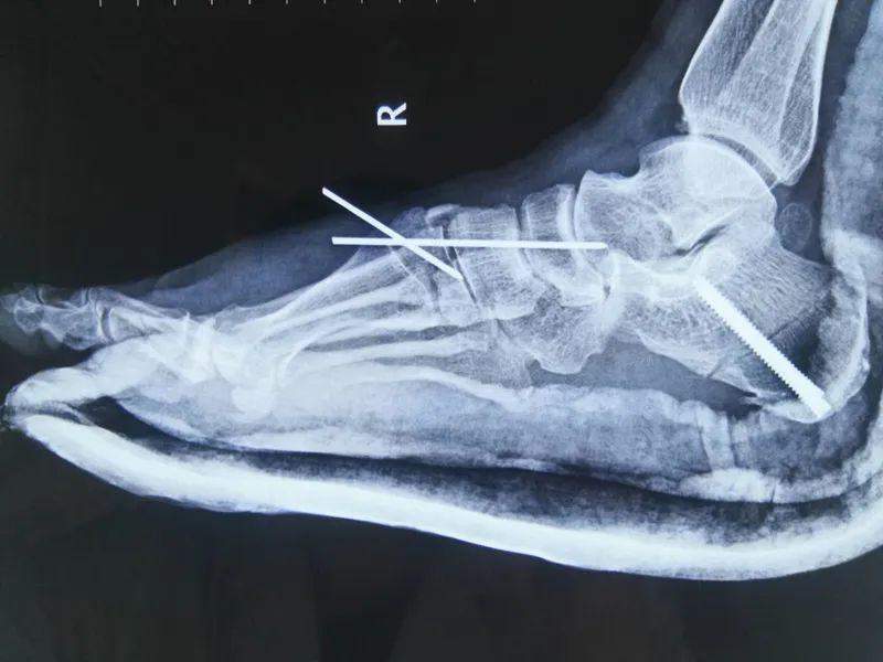 手足外科微创手术,巴彦淖尔市医院手足显微外科