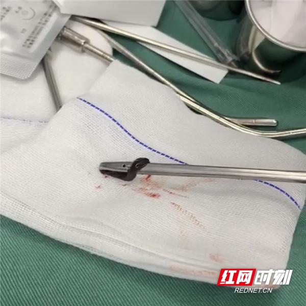 男子咳血4年竟是蚂蟥寄居鼻腔中,女子咳血后发现体内竟有蚂蝗