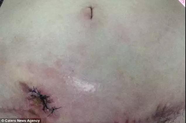 “我23岁，包里装满了纸尿裤”：那些被减肥毁掉的中国女孩们