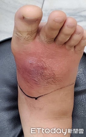 手外伤肿痛可以扎针灸吗,不要小看小手术伤口感染