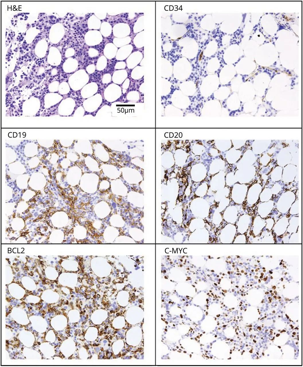 脑血管串珠样改变,脑卒中的临床及影像表现