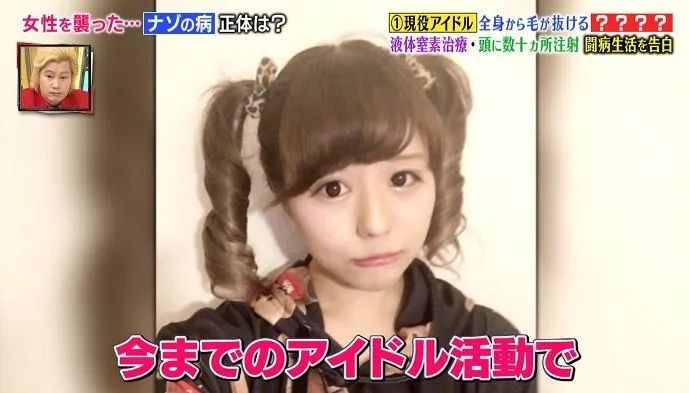 日本16岁美少女偶像歌手脱发到光头！“沦为”假发模特后的她，没有忘记自己甜美的笑容...