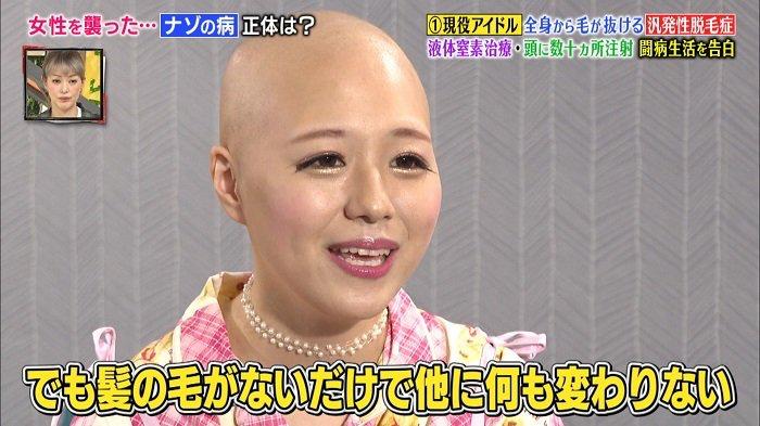 日本16岁美少女偶像歌手脱发到光头！“沦为”假发模特后的她，没有忘记自己甜美的笑容...