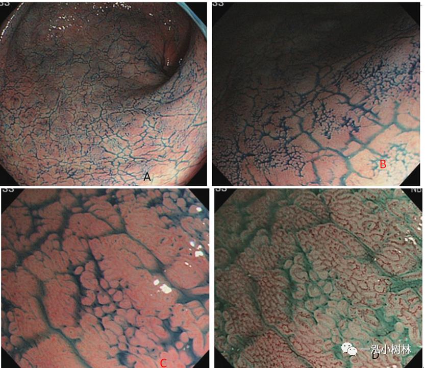 肠上皮化生做什么检查,肠化生内镜看得出来吗