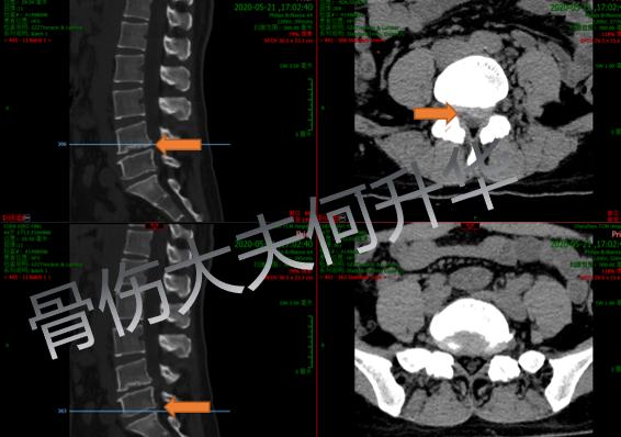 【谈骨论筋】我的腰椎做了微创手术为什么还会痛？一文带你了解术后疼痛原因及防治方法