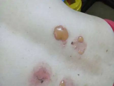 贴三伏贴起泡是怎么回事,三伏贴起泡后还能再贴吗