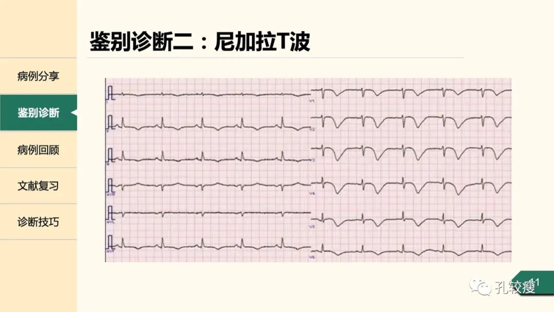 t波倒置在心电图中怎么看,T波低平心电图讲解